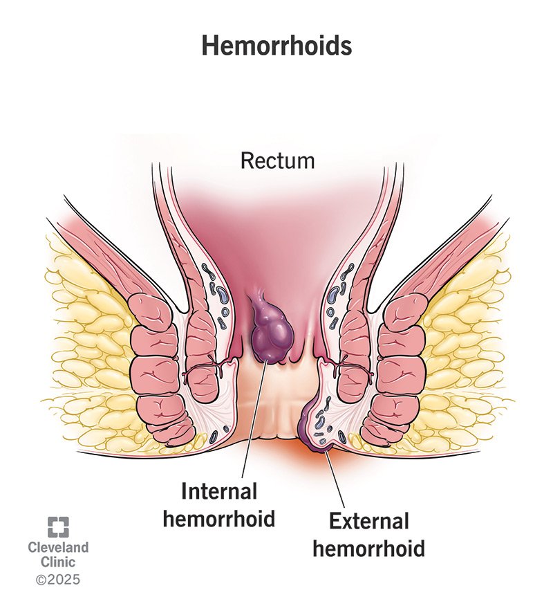HEMORRHOIDS (PILES)